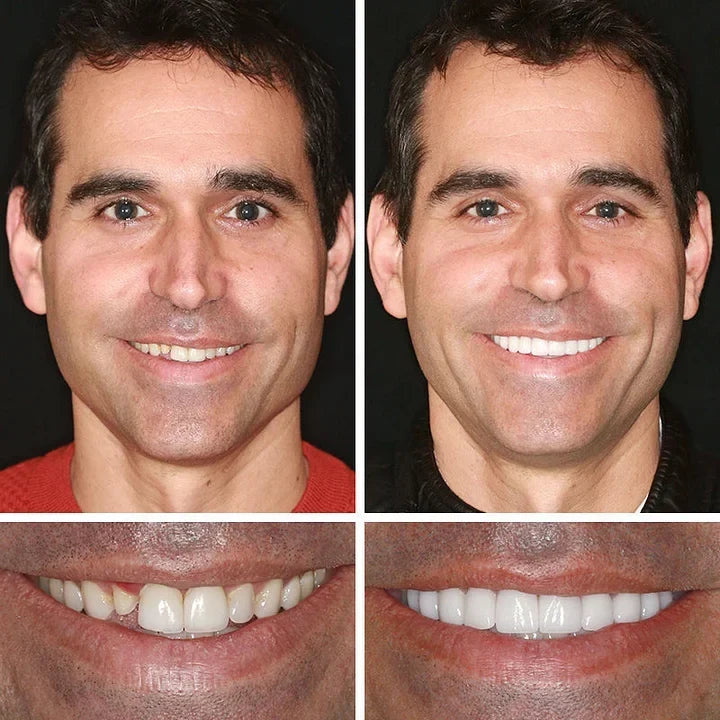 🔥🔥Ends Today: 75% OFF!🦷 DarkFairy™ Custom-Fit Denture
