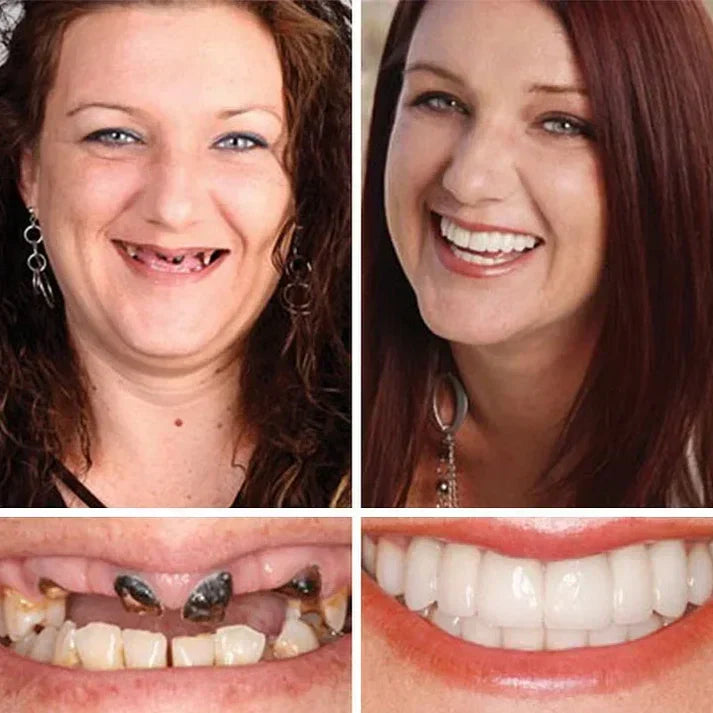 Ends Today: 70% OFF!  🏆2026 Bestselling Product🦷 Fit for a Fresh Smile, Say Goodbye to Wearing Discomfort!🌎